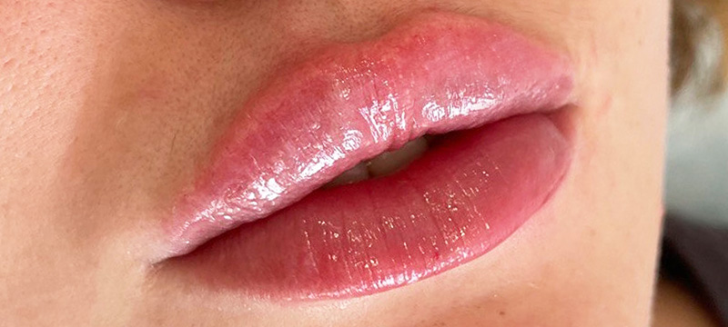 Контурная пластика лица: красота без хирургии